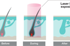 Epilare-Definitiva-Elysion-Pro